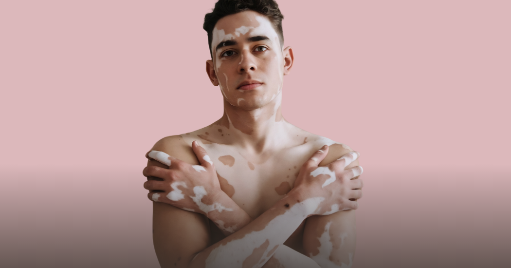 Ένας άνδρας που έχει λευκές κηλίδες πάνω στο σώμα του και το αγκαλιάζει.