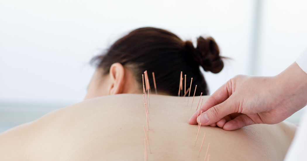 Μια γυναίκα ξαπλωμένη με βελόνες βελονισμού στην πλάτη της.